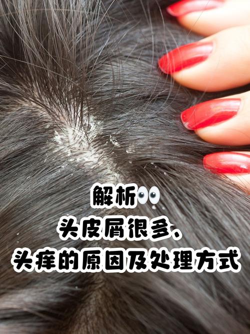 头皮痒头皮屑多传染吗？对比3种治疗方法更有效