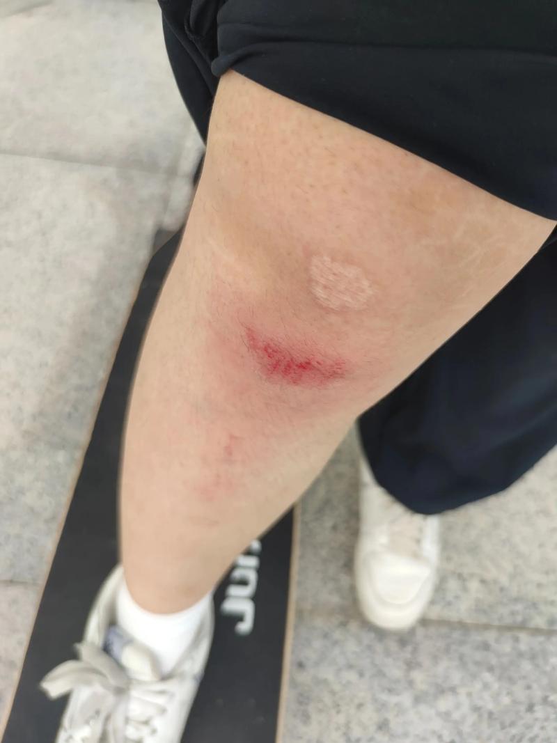 滑板男孩受伤怎么办？这几个保护措施一定要做好！