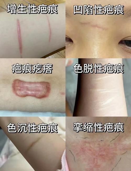 重结缔皮和普通疤痕一样吗？教你一招快速区分它们！