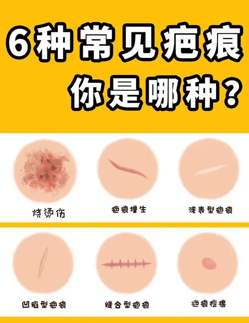重结缔皮和普通疤痕一样吗？教你一招快速区分它们！