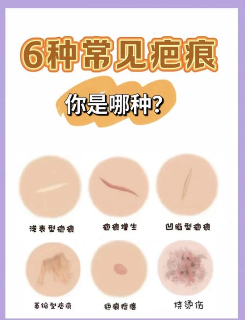 重结缔皮和普通疤痕一样吗？教你一招快速区分它们！